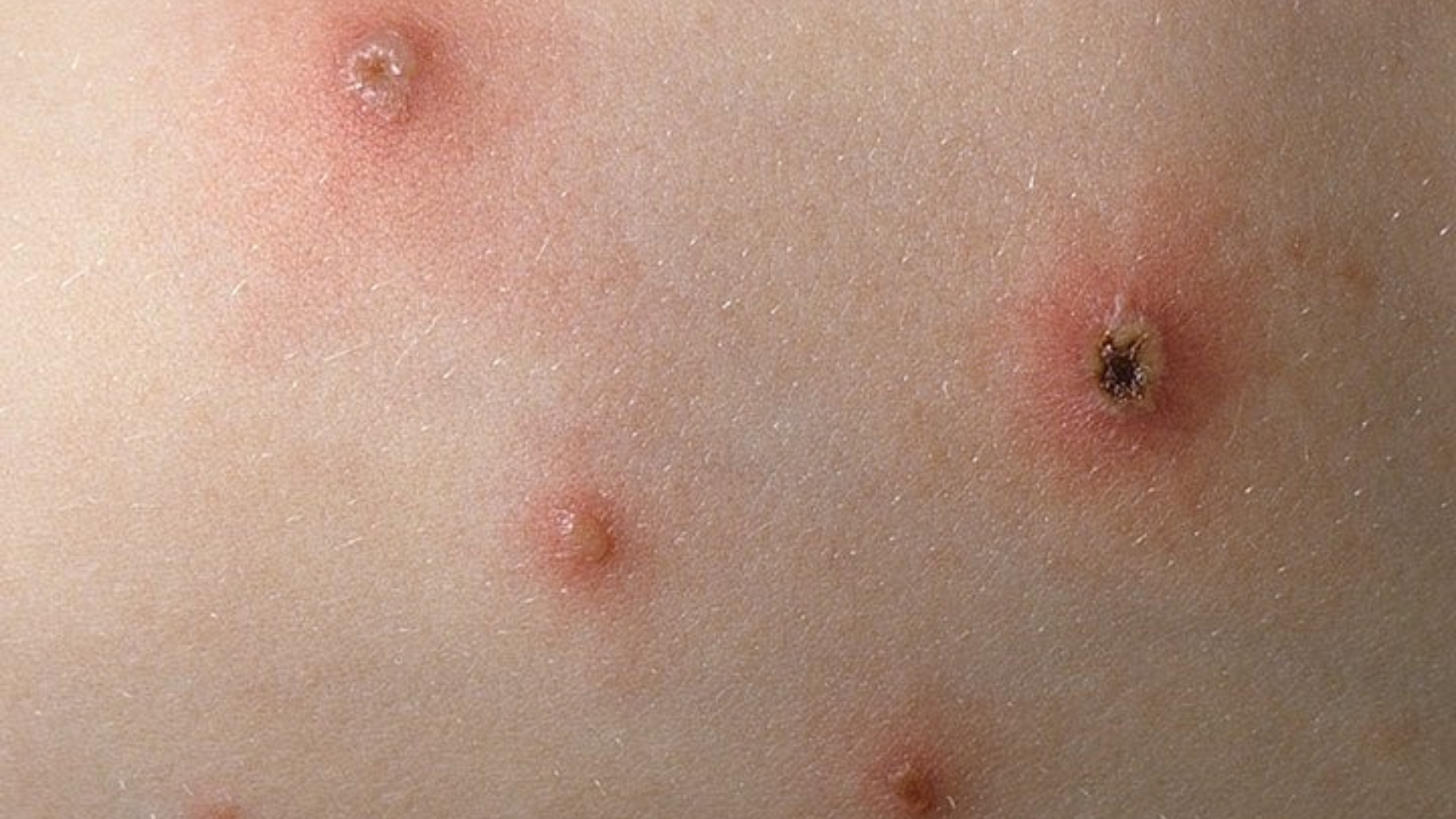 hinh-anh-benh-thuy-dau-o-tre-em-qua-tung-giai-doan-tien-trien-benh-4