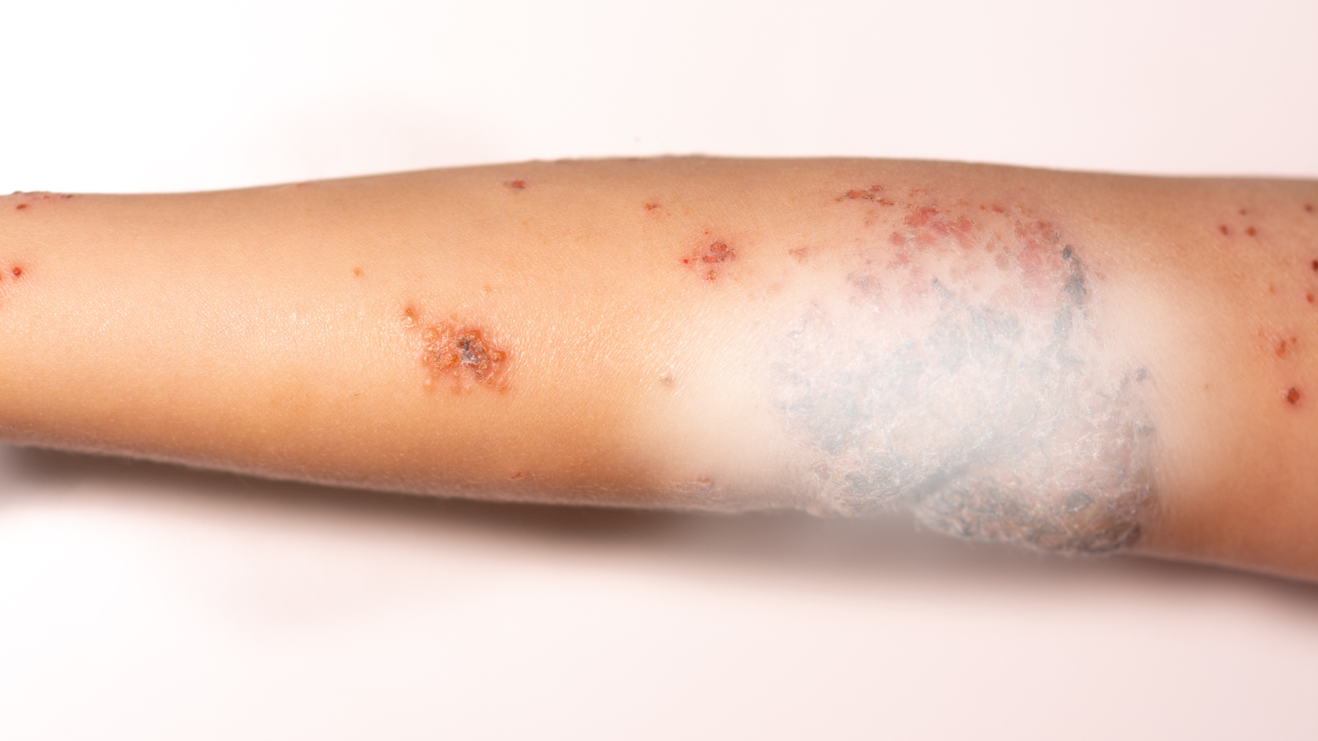 Sau khi khỏi, chốc loét có thể để lại sẹo