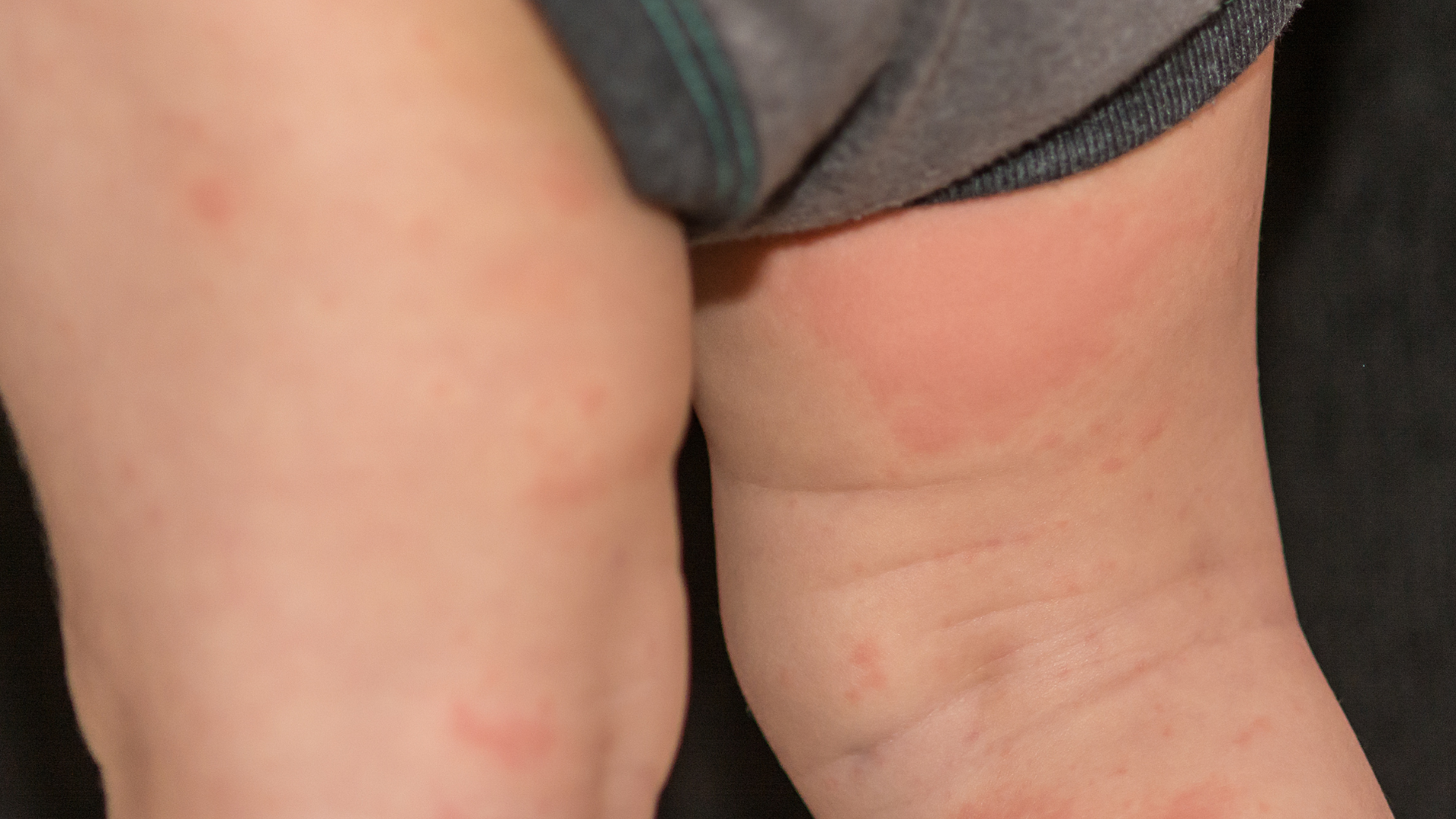 Hăm kẽ thường xuất hiện ở các nếp gấp như kẽ bẹn, kẽ mông