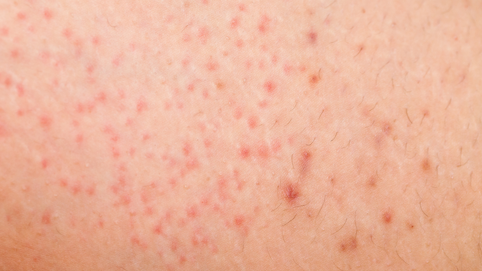 Nhận diện hình ảnh viêm nang lông nông