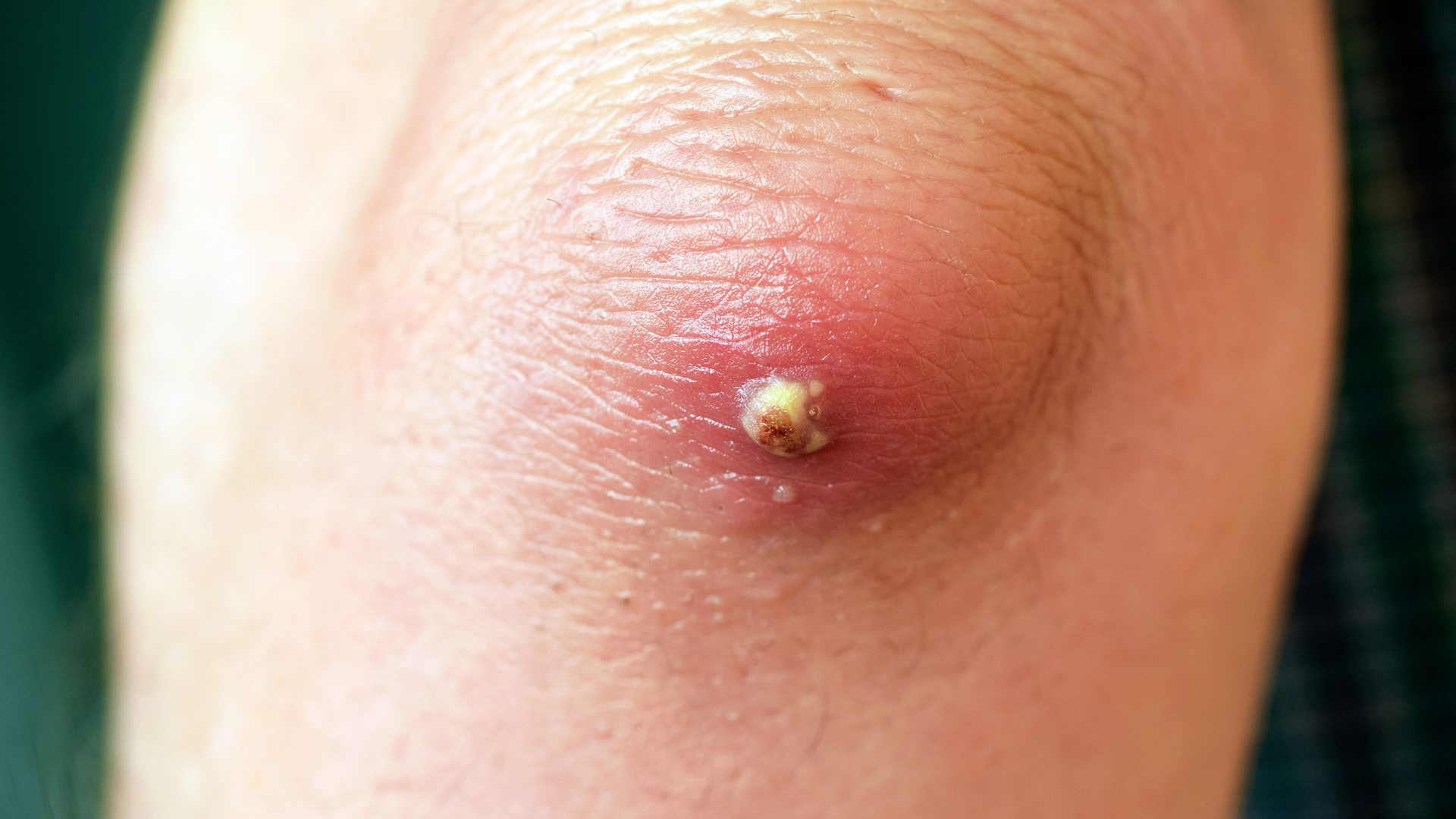 Nhọt ổ gà có thể tạo thành vùng mủ lan rộng