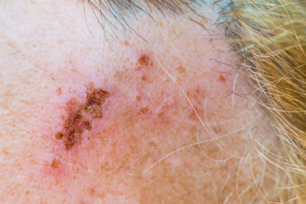 hinh-anh-bi-gioi-leo-qua-tung-giai-doan-se-co-trieu-chung-nhu-the-nao 2.png