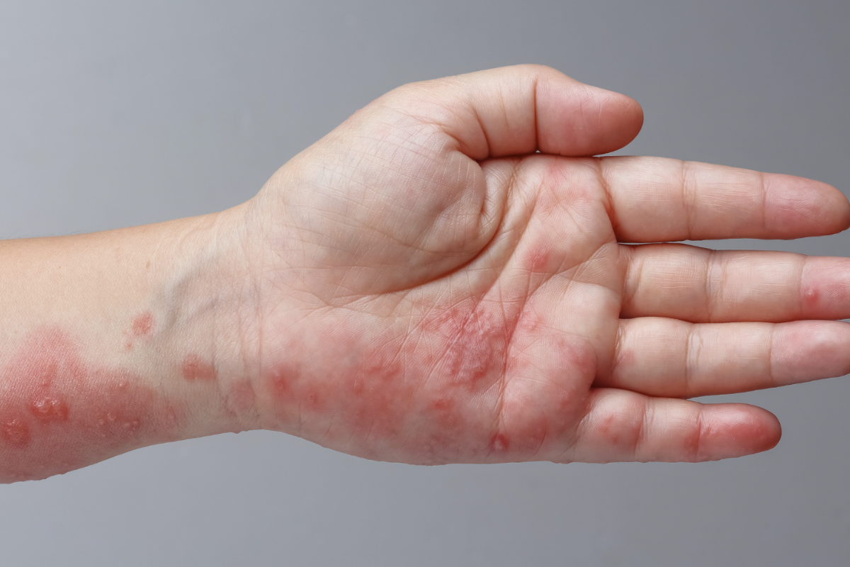 hinh-anh-bi-gioi-leo-qua-tung-giai-doan-se-co-trieu-chung-nhu-the-nao 4.png