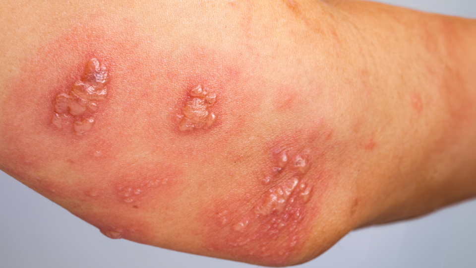 hinh-anh-bi-gioi-leo-qua-tung-giai-doan-se-co-trieu-chung-nhu-the-nao 7 Cropped.png