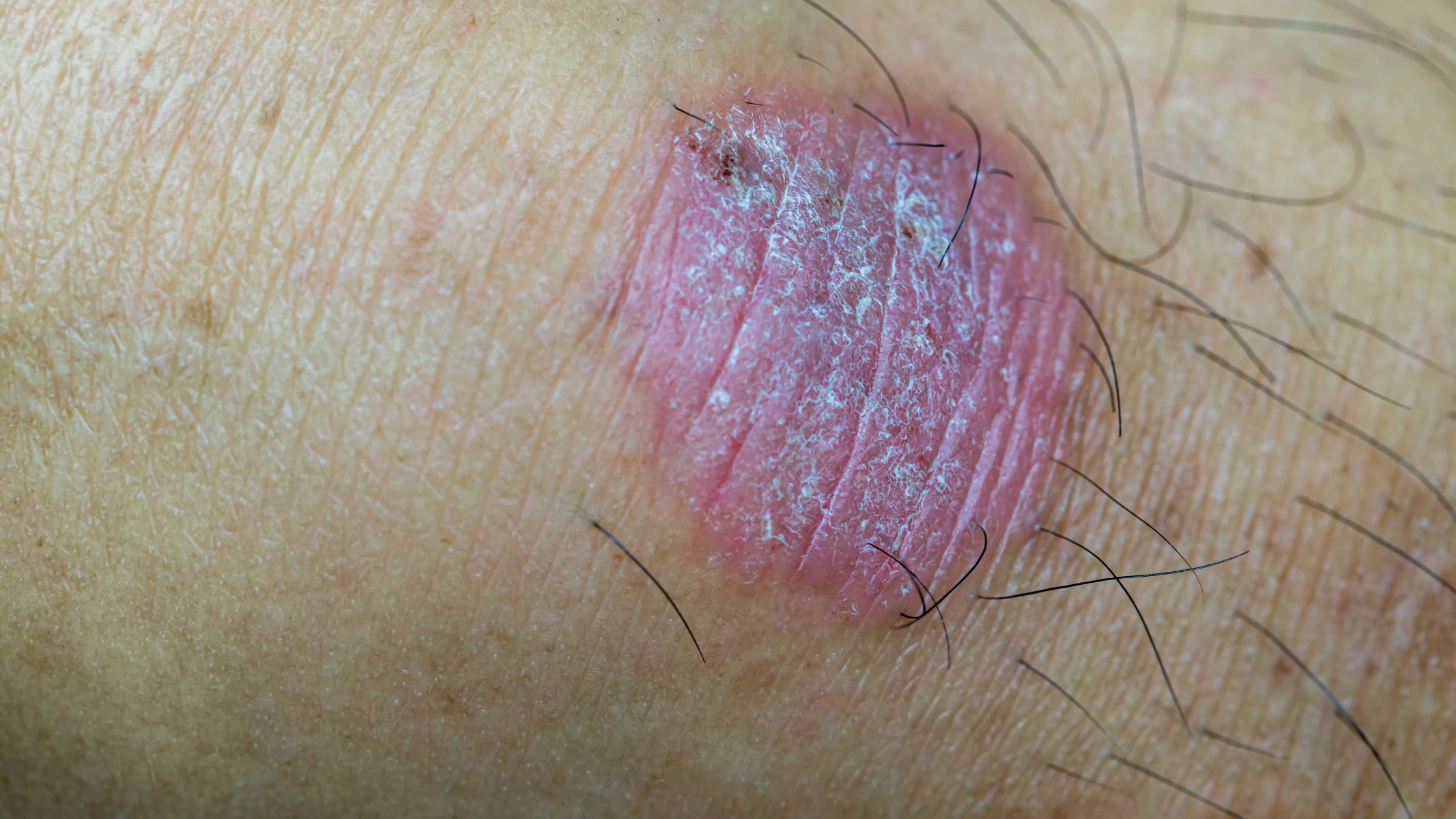 Gãi nhiều có thể làm trầy xước da, tạo điều kiện cho vi khuẩn xâm nhập gây bội nhiễm