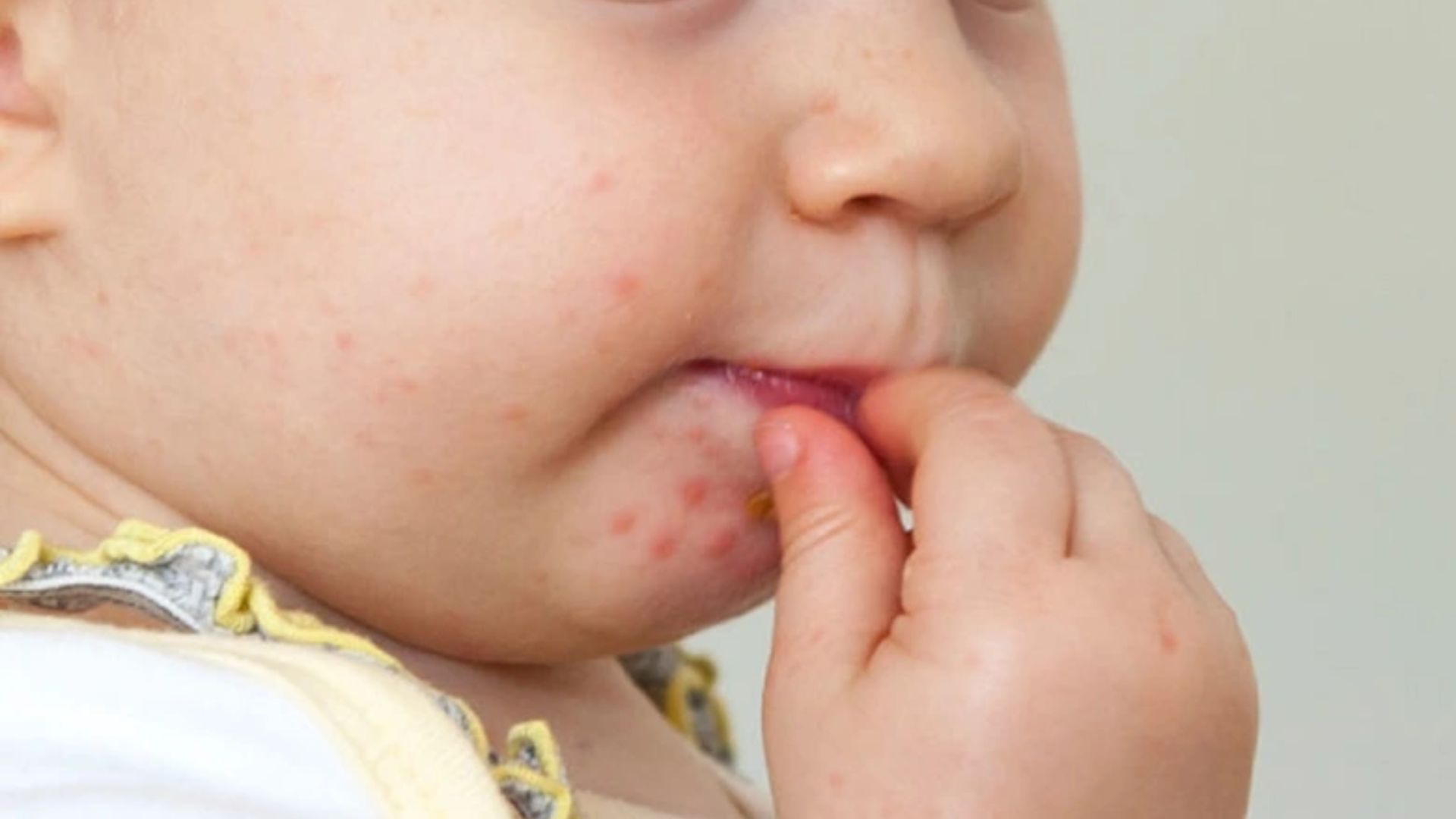 Tay chân miệng là bệnh thường gặp ở trẻ, gây mụn nước trong miệng kèm theo ở tay và chân