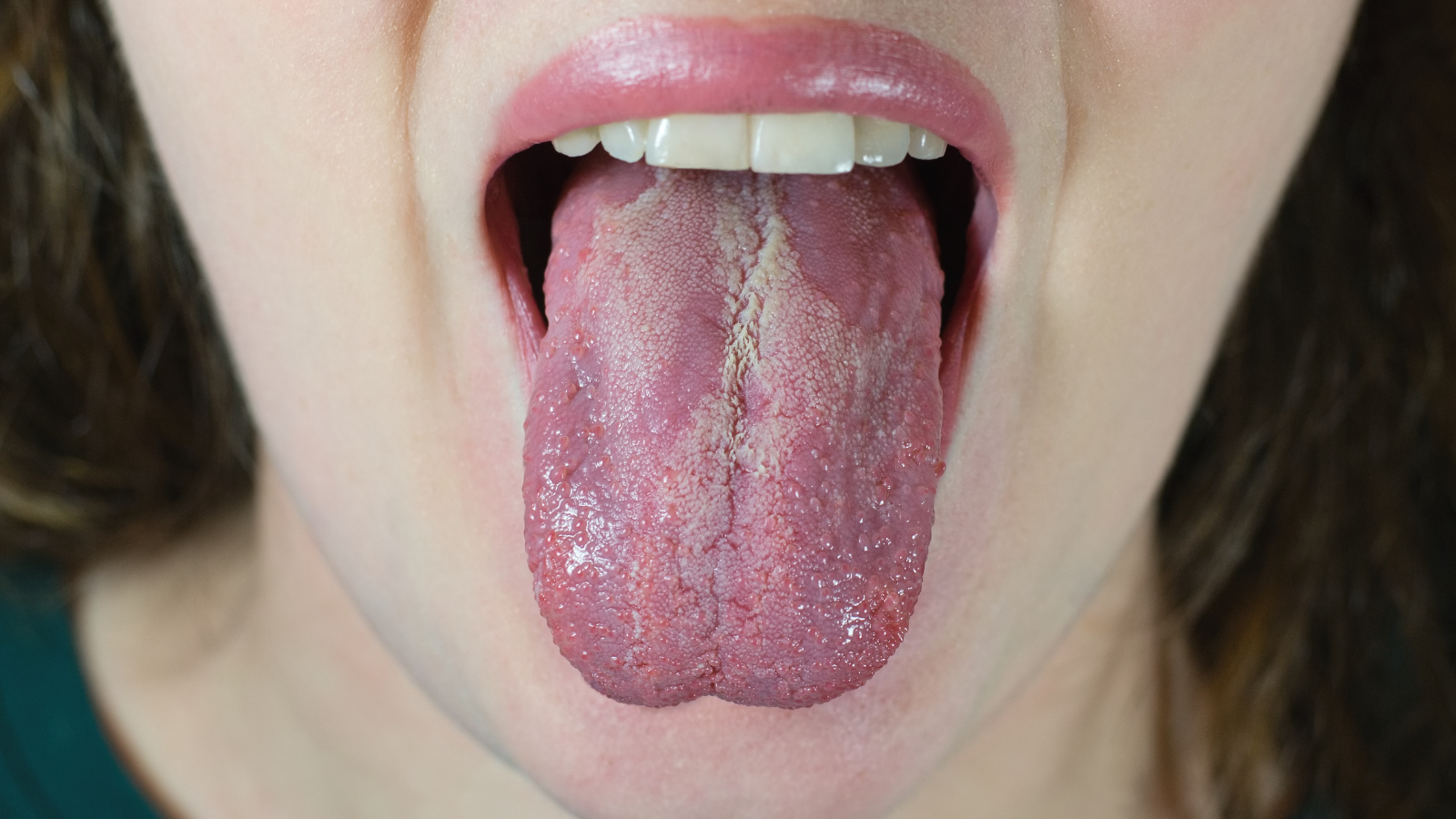 Soi tươi dịch phết từ các mảng bám này sẽ giúp xác định sự hiện diện của nấm miệng