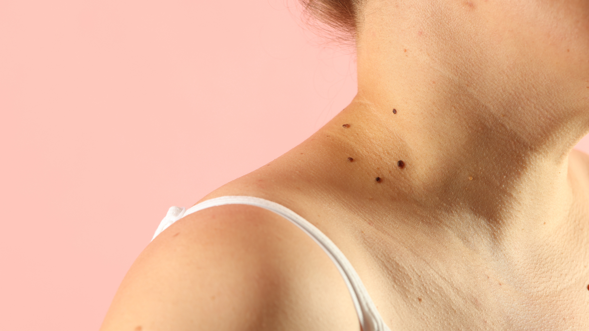 Hình ảnh nốt ruồi ung thư thường được dùng để mô tả các tổn thương sắc tố trên da có đặc điểm bất thường