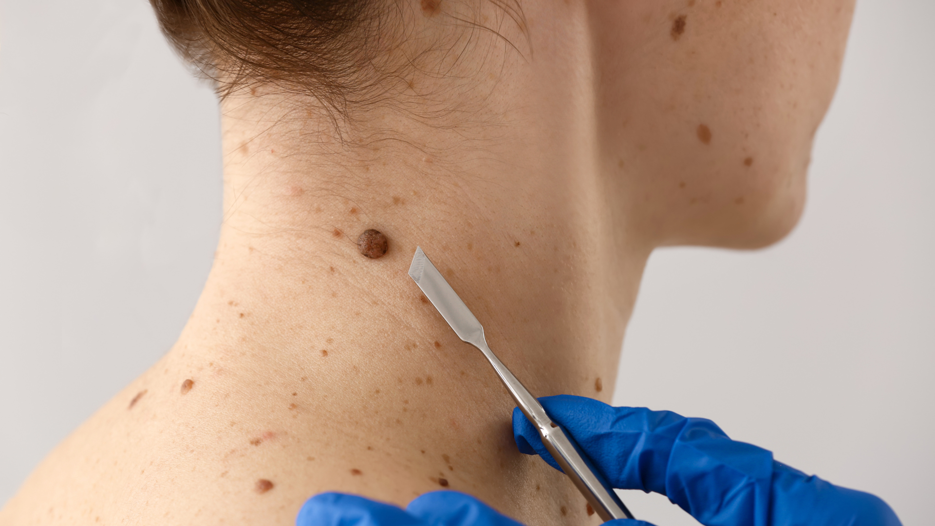 Những người có người thân từng mắc ung thư da có thể có nguy cơ cao hơn so với người bình thường