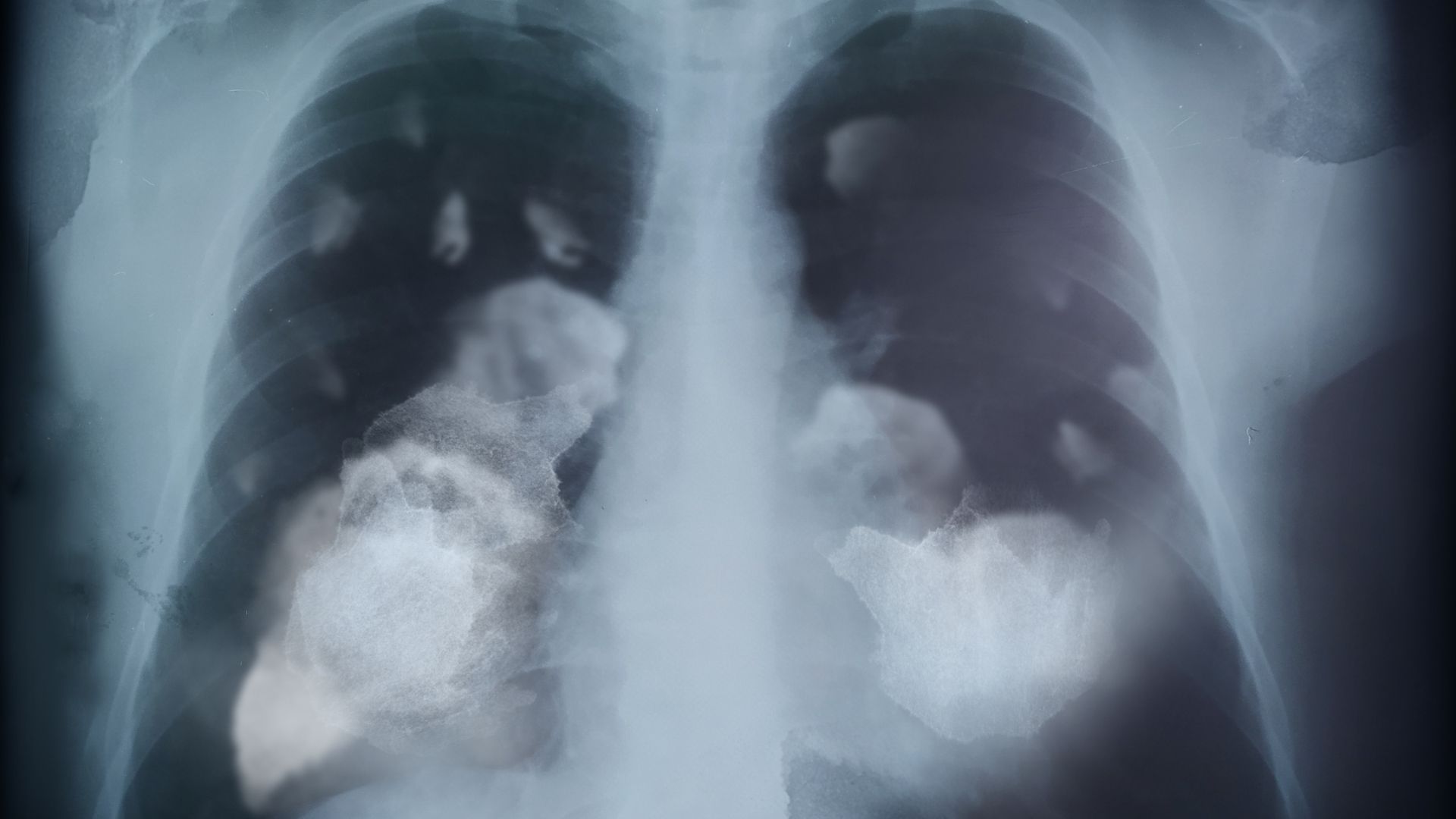 Hình ảnh phổi bị ung thư có những vùng đặc bất thường