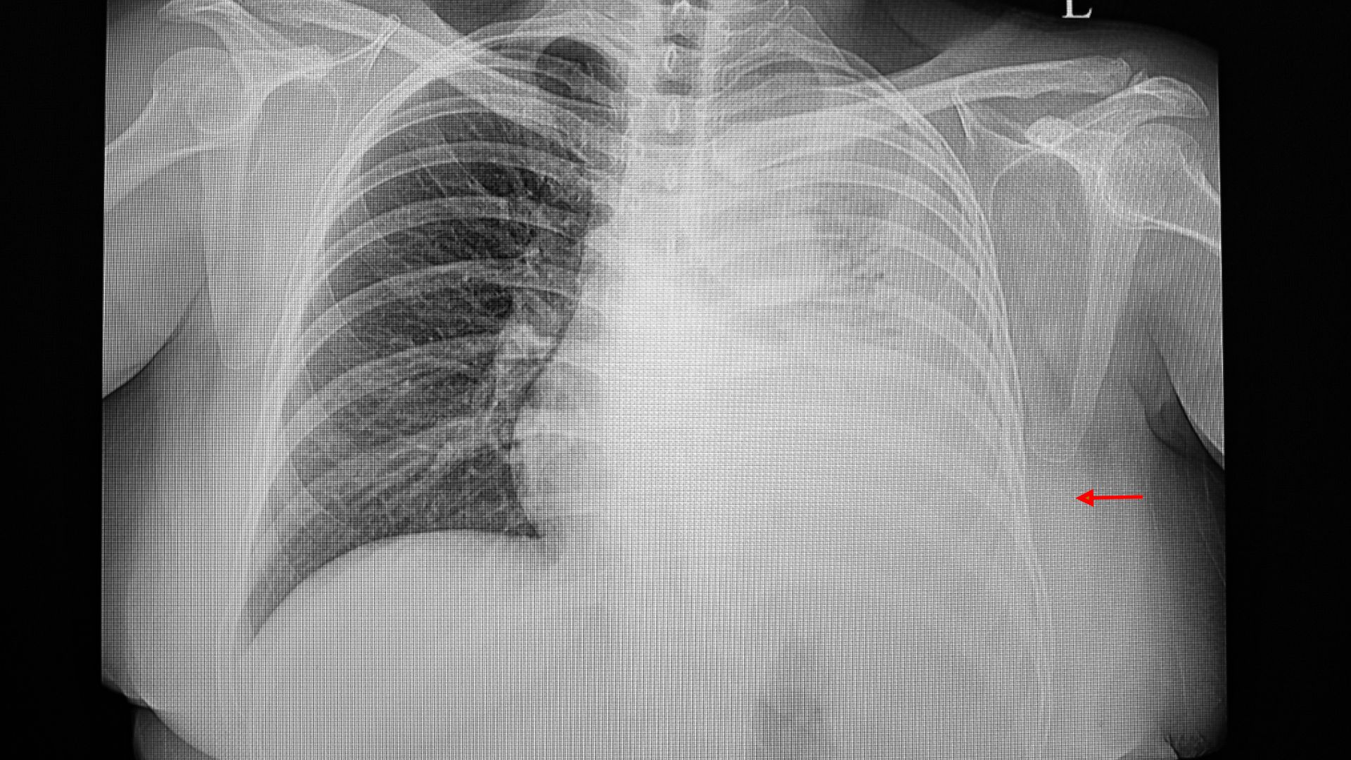 Ung thư phổi ở giai đoạn muộn có thể gây tràn dịch màng phổi