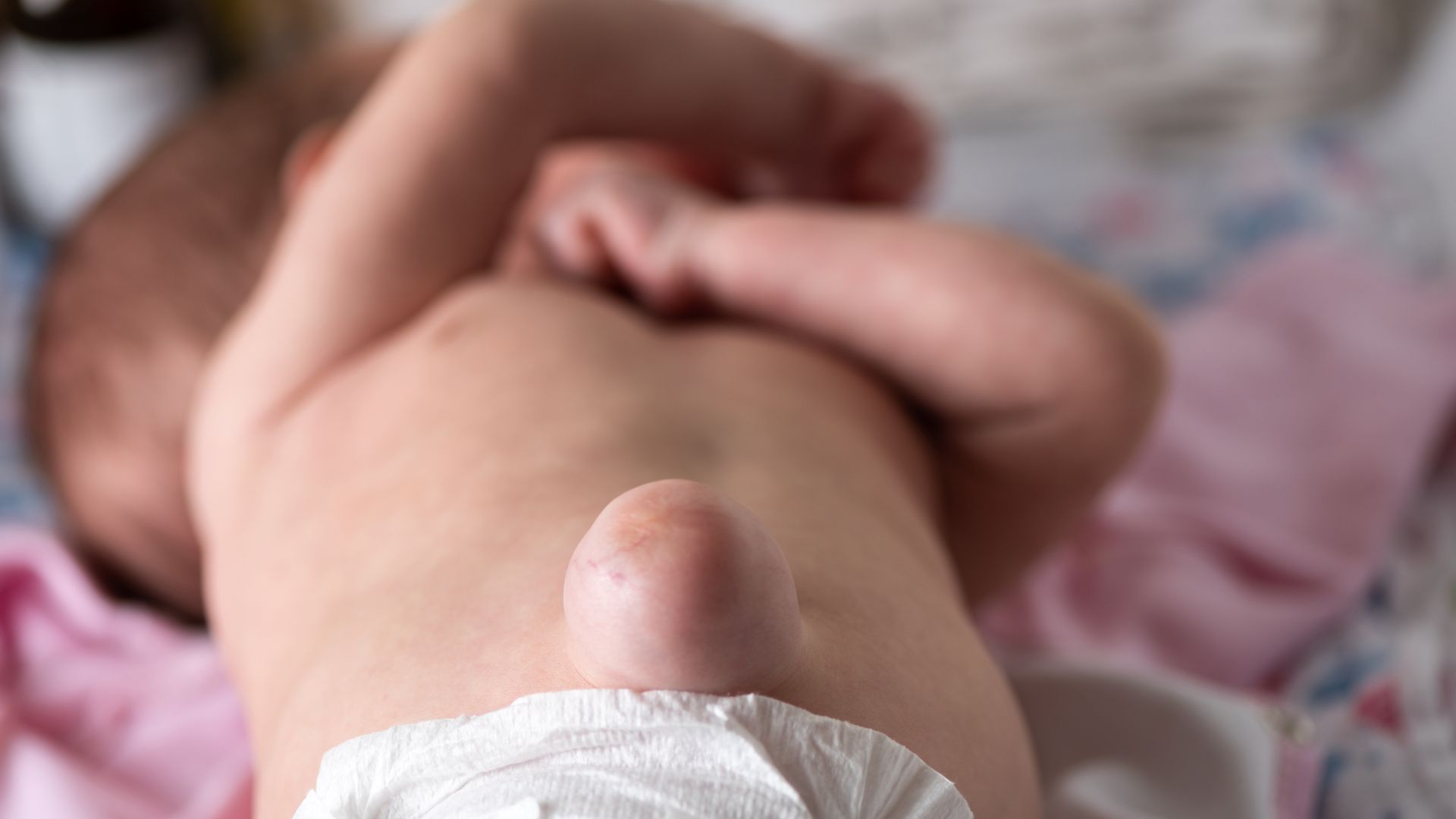 Hình ảnh rốn lồi ở trẻ sơ sinh: Nguyên nhân, cách nhận biết và xử lý 1
