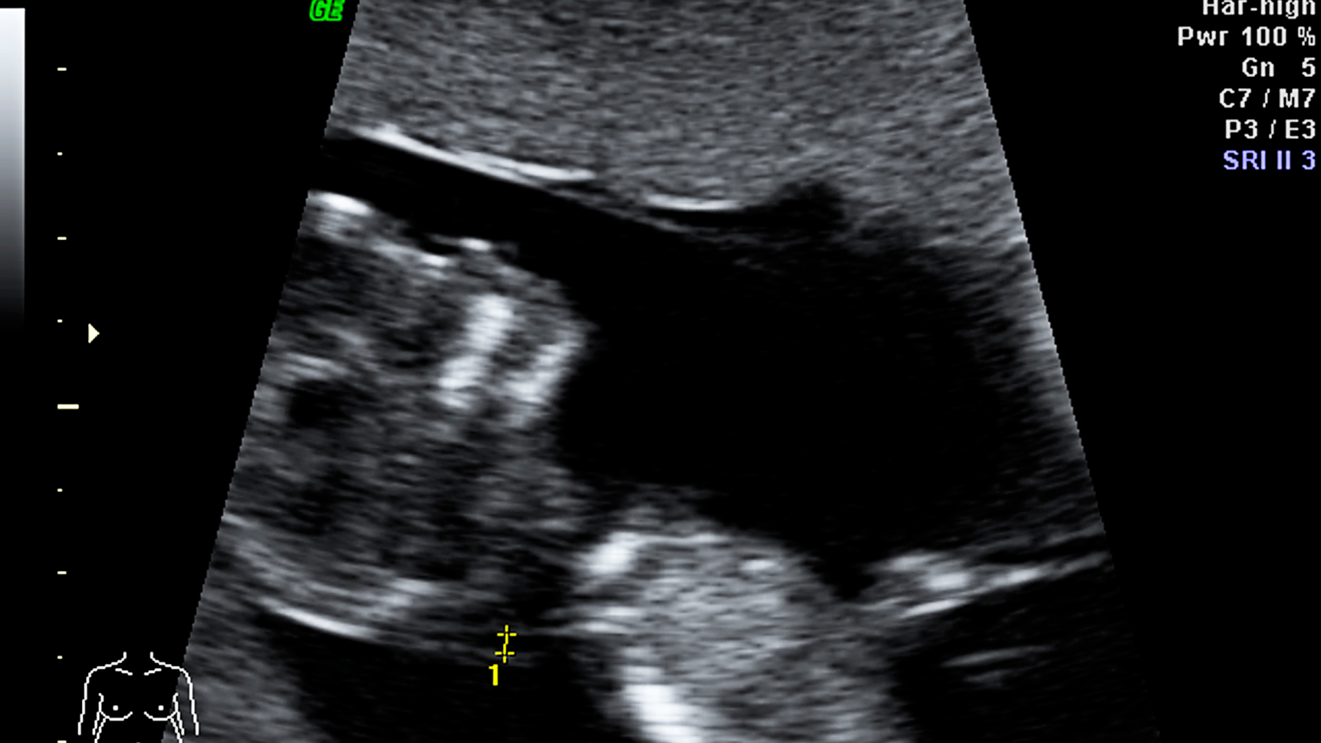 Hình ảnh siêu âm bé trai 12 tuần qua góc nub đặc trưng