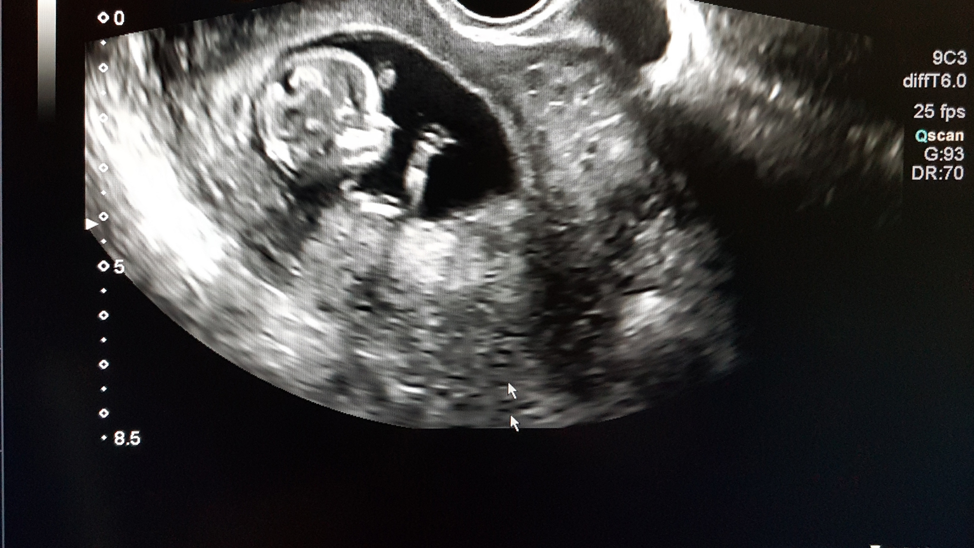 Dấu hiệu nhận biết hình ảnh siêu âm bé 12 tuần