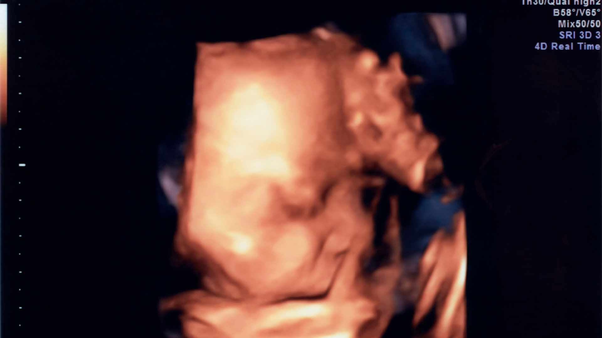 Hình ảnh siêu âm thai nhi bị hở hàm ếch giúp bác sĩ phát hiện sớm dị tật vùng hàm mặt