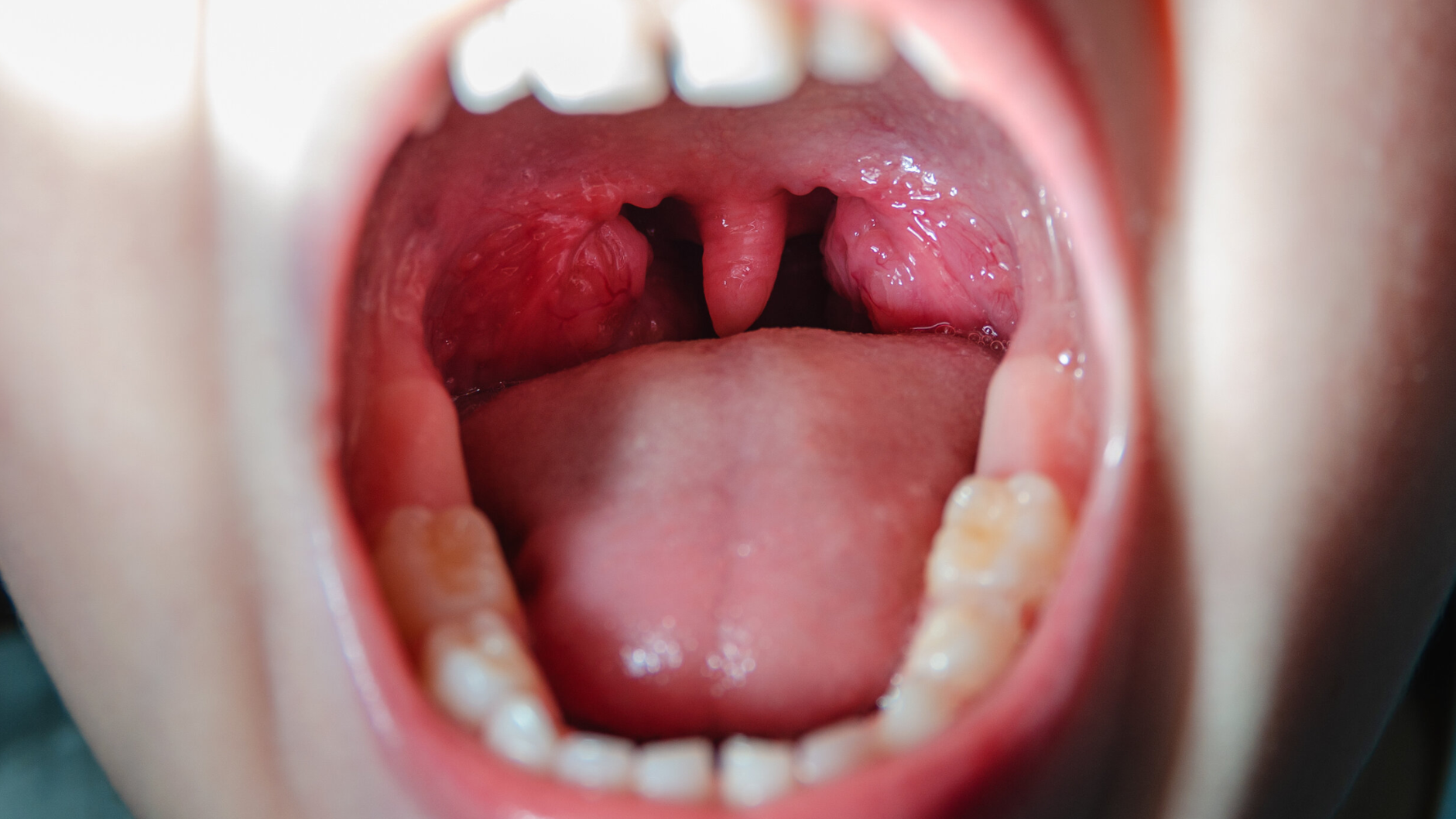 Hình ảnh amidan trước khi cắt