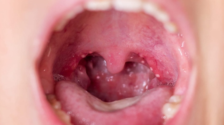 Hình ảnh sau khi cắt amidan