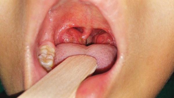 So sánh hình ảnh trước và sau khi cắt amidan