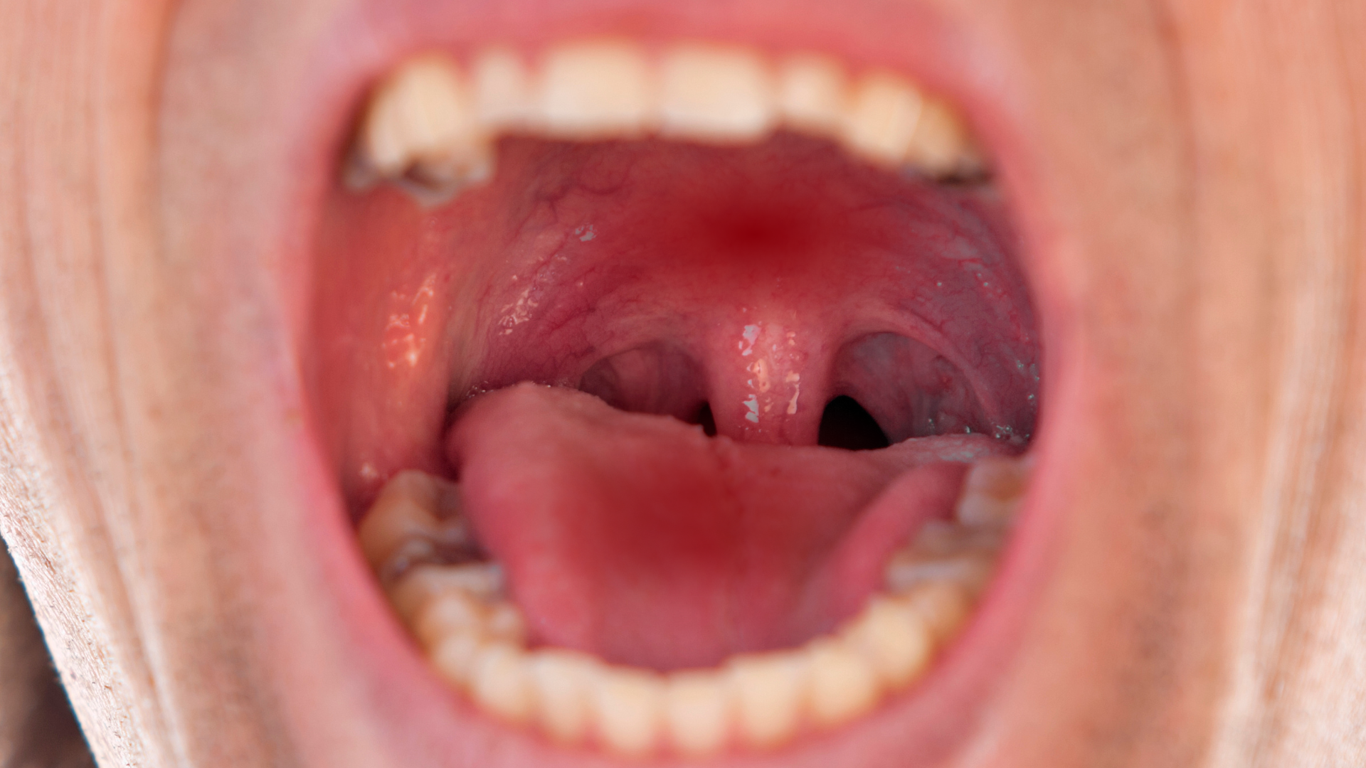 Hình ảnh ung thư vòm họng giai đoạn 1 dễ bị nhầm với viêm mũi họng thông thường