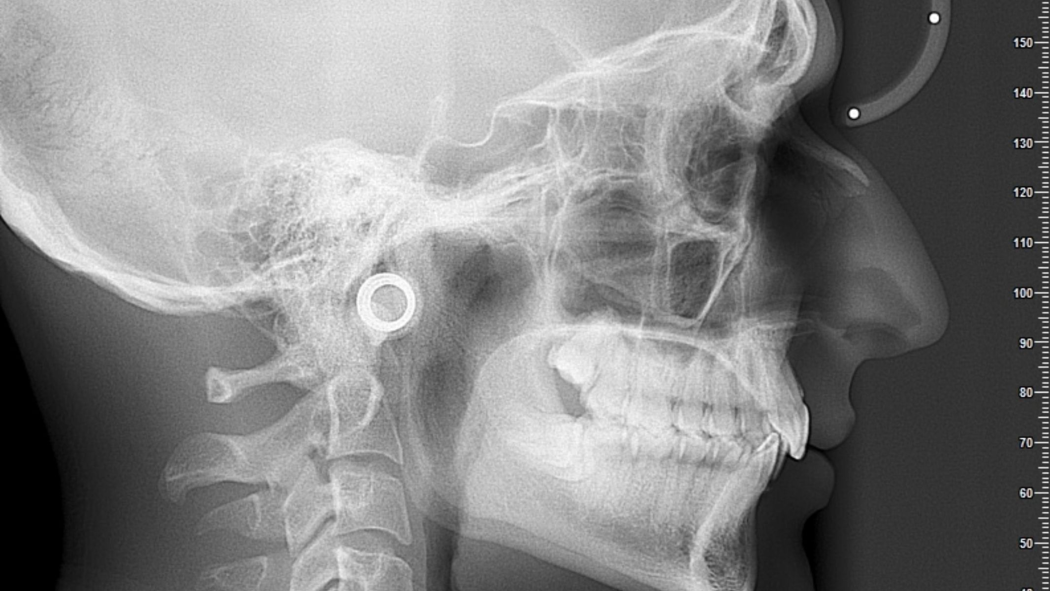 Hình ảnh ung thư xương quai hàm đóng vai trò trung tâm trong việc đánh giá tổn thương ác tính tại vùng hàm mặt