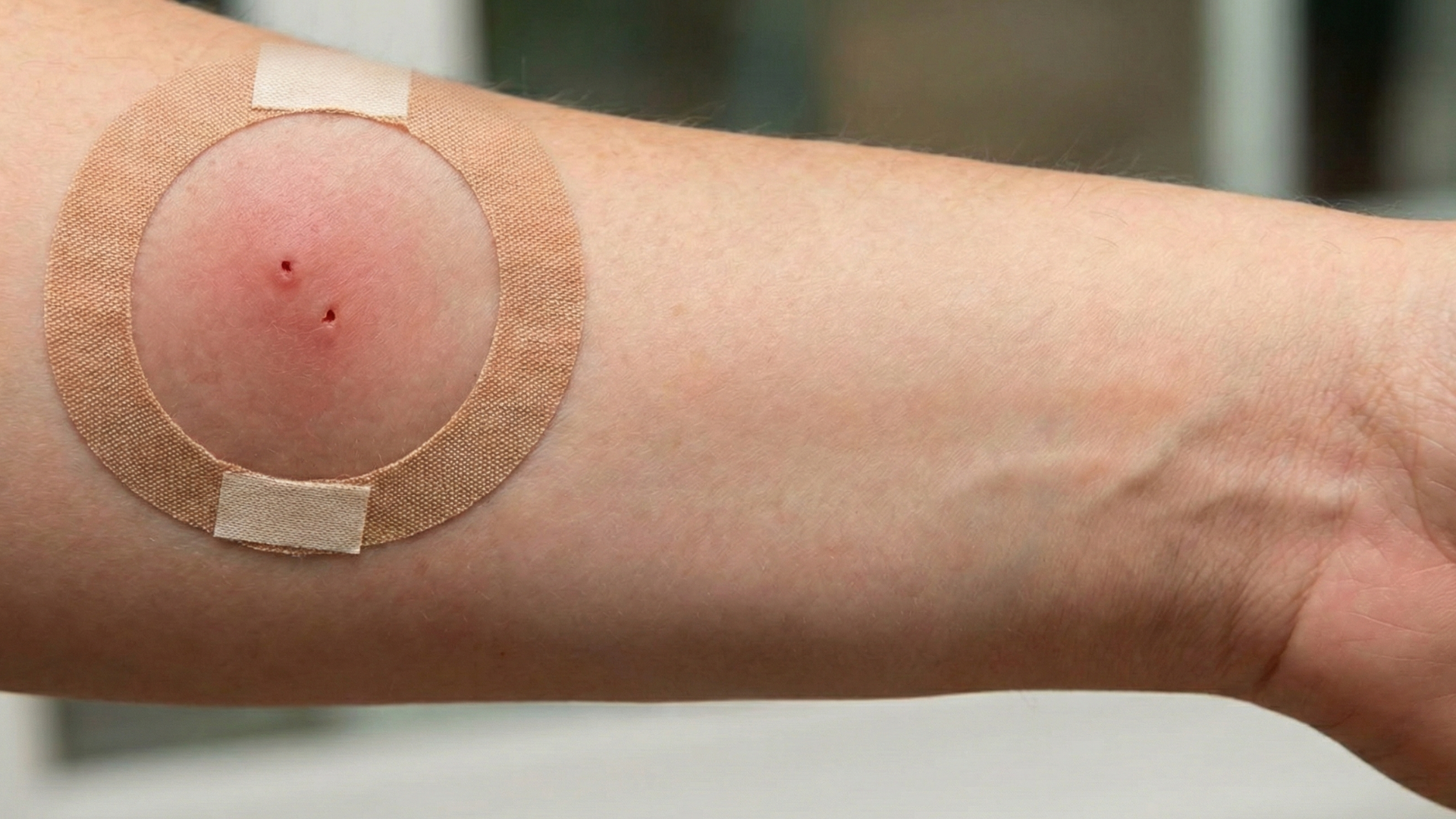 Hình ảnh vết chuột cắn có thể khác nhau tùy mức độ