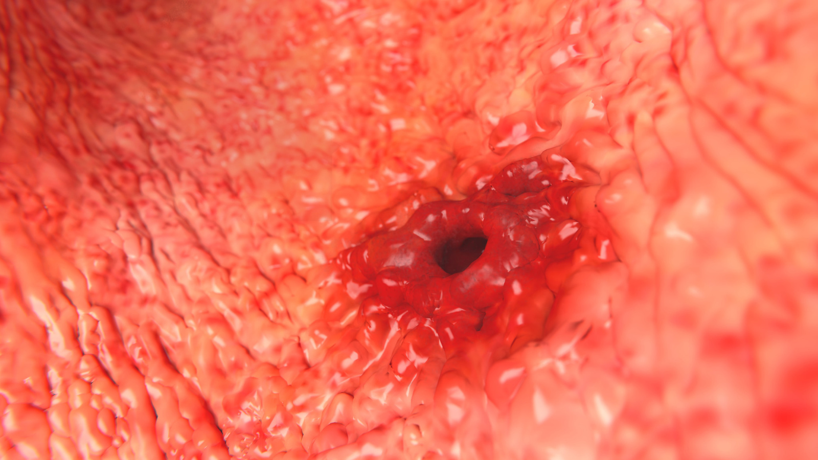 Ổ viêm ăn sâu tạo thành vết loét và gây vỡ mạch máu lớn