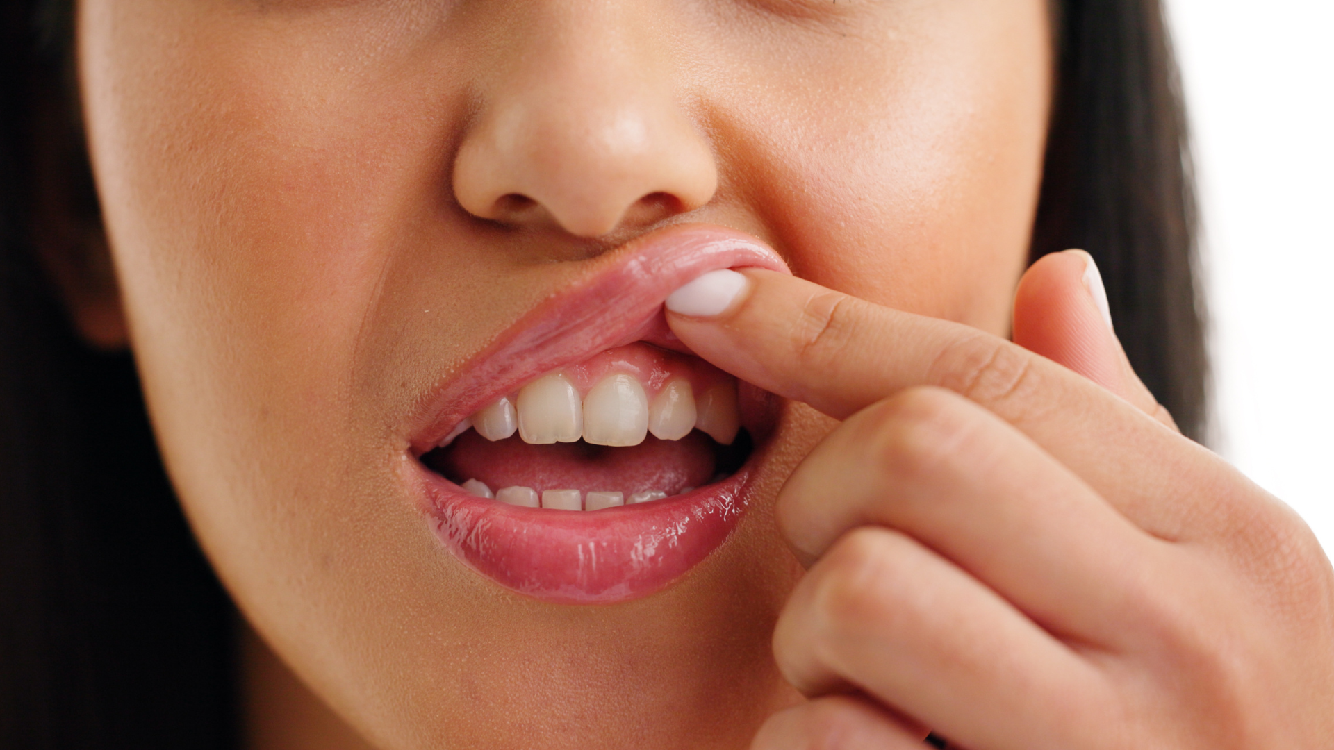 Cần phân biệt hình ảnh viêm niêm mạc miệng với các bệnh lý khác