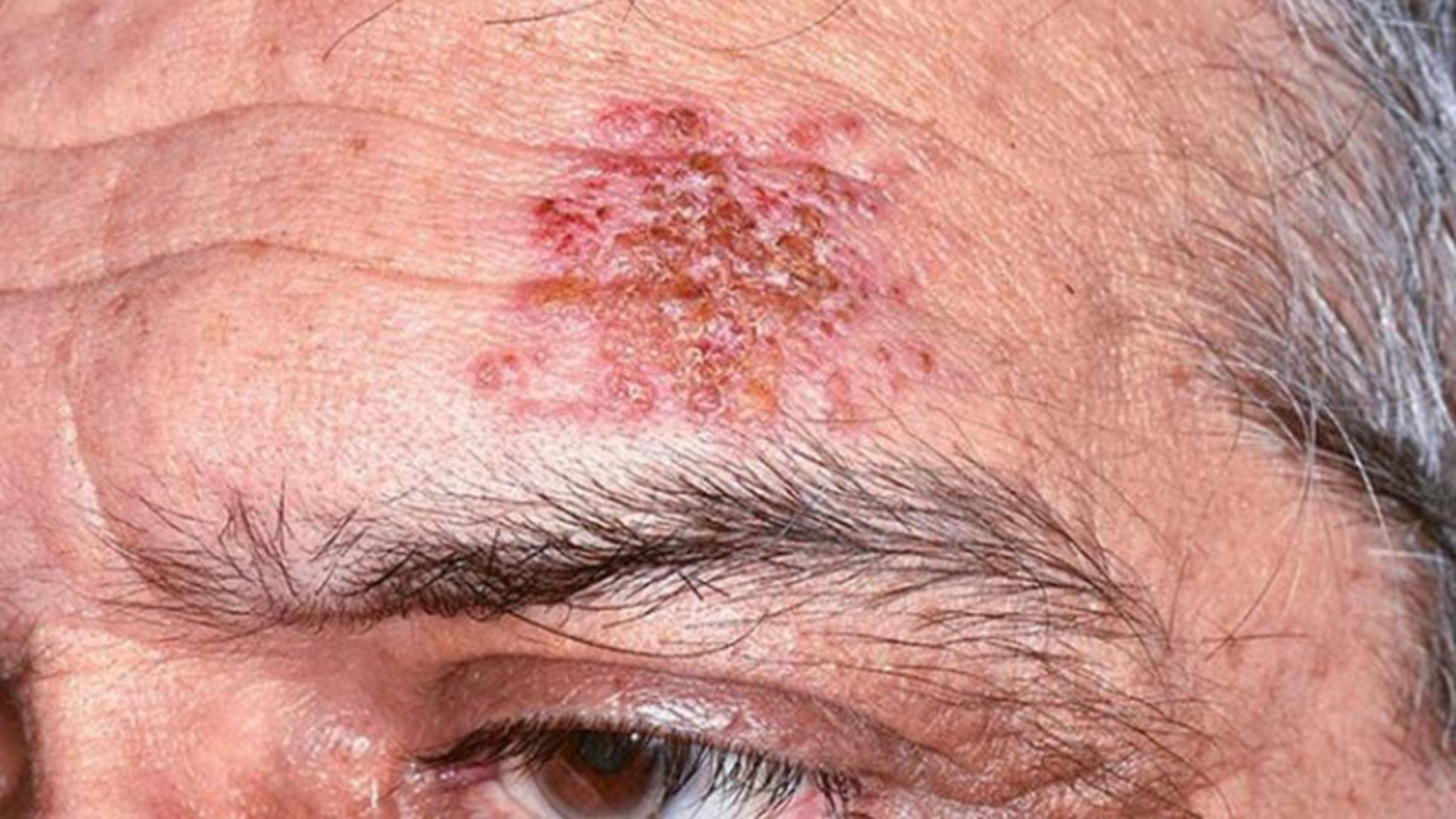 Hình ảnh zona thần kinh ở mặt theo các giai đoạn 4