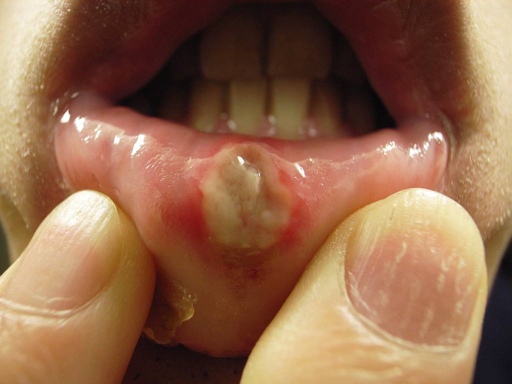 HIV lây qua đường nước bọt không? 2