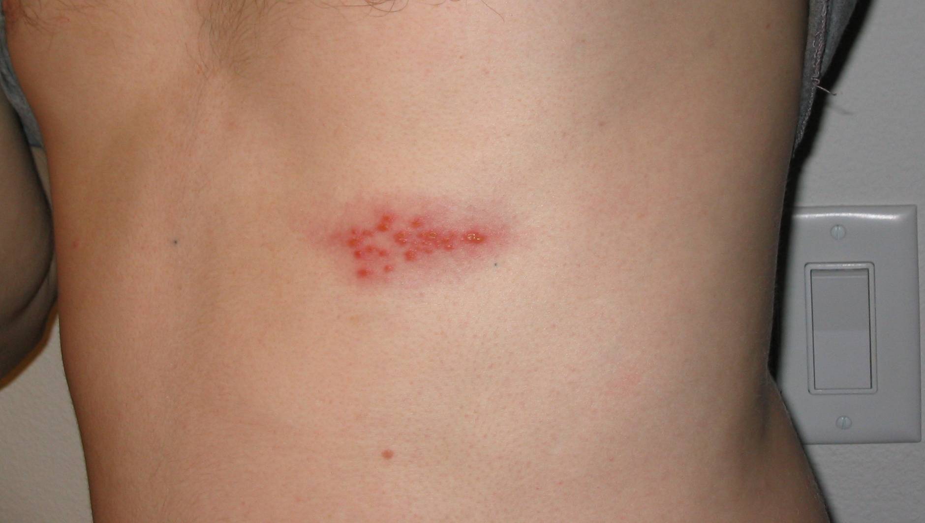 HIV lây qua đường nước bọt không? 3