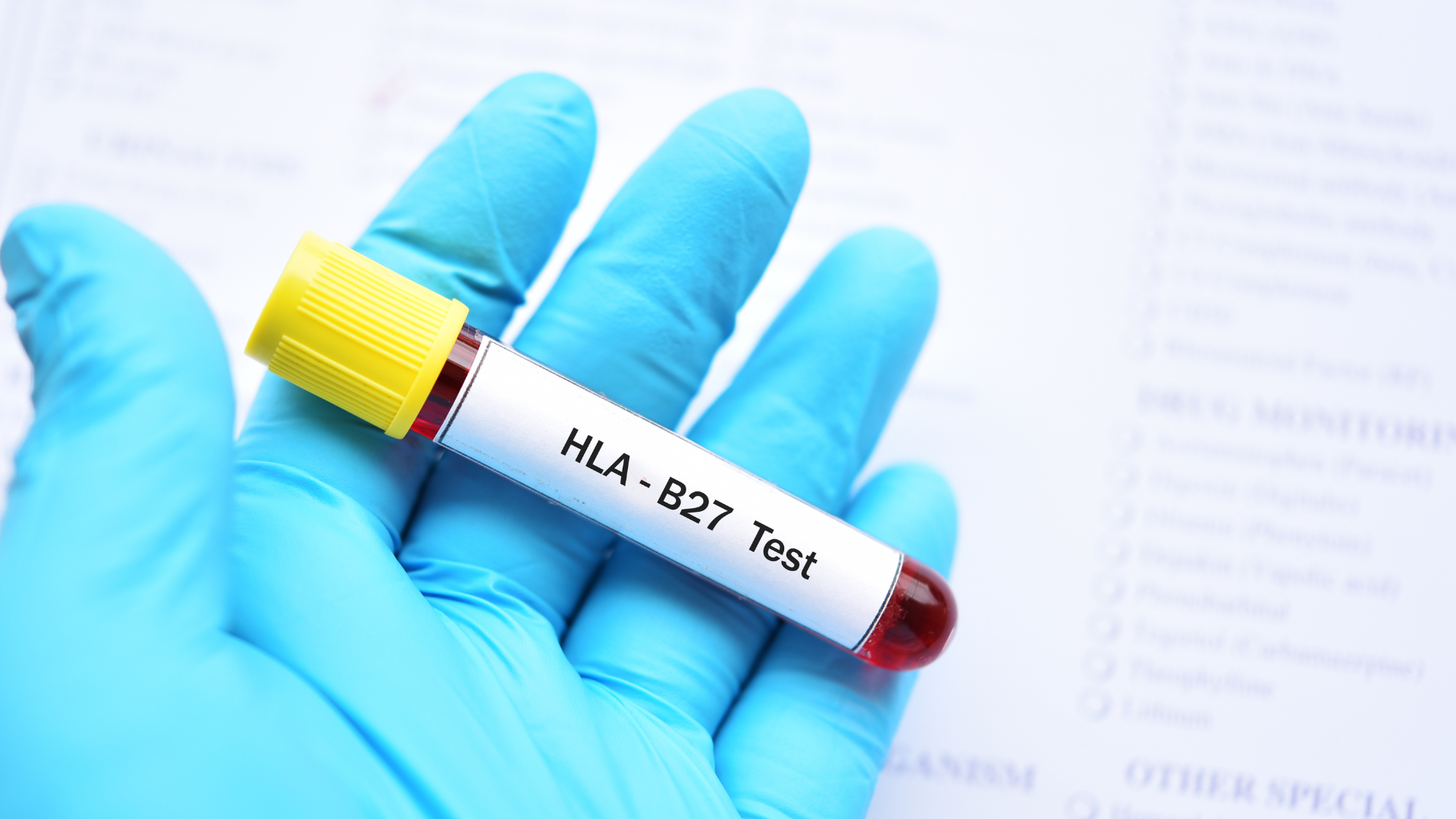 HLA B27 là một dấu ấn di truyền có mối liên hệ chặt chẽ với nhiều bệnh lý viêm khớp và bệnh tự miễn