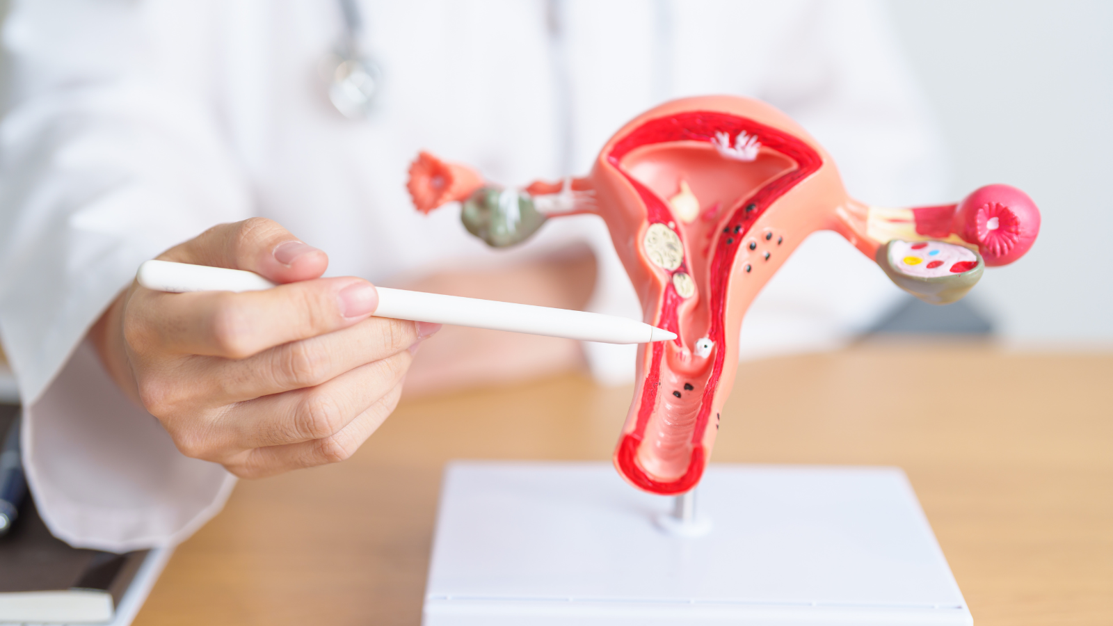 Hở eo tử cung là tình trạng cổ tử cung giãn ra sớm trong tam cá nguyệt thứ hai