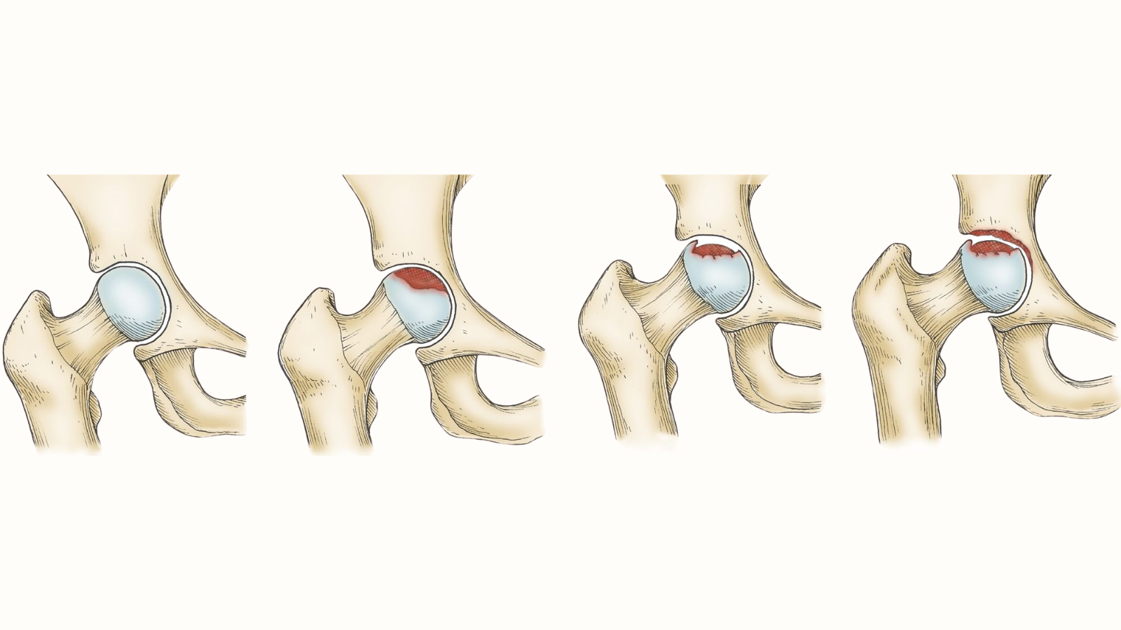 Hoại tử chỏm xương đùi có thể gây biến dạng khớp háng nếu không được điều trị kịp thời