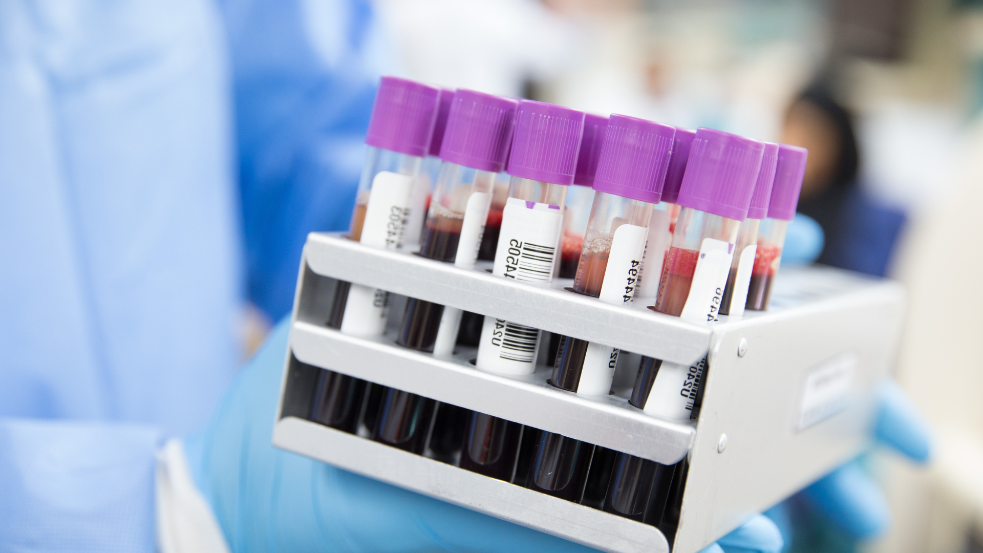 Hội chứng tăng bạch cầu ưa axit là bệnh lý rối loạn hiếm gặp