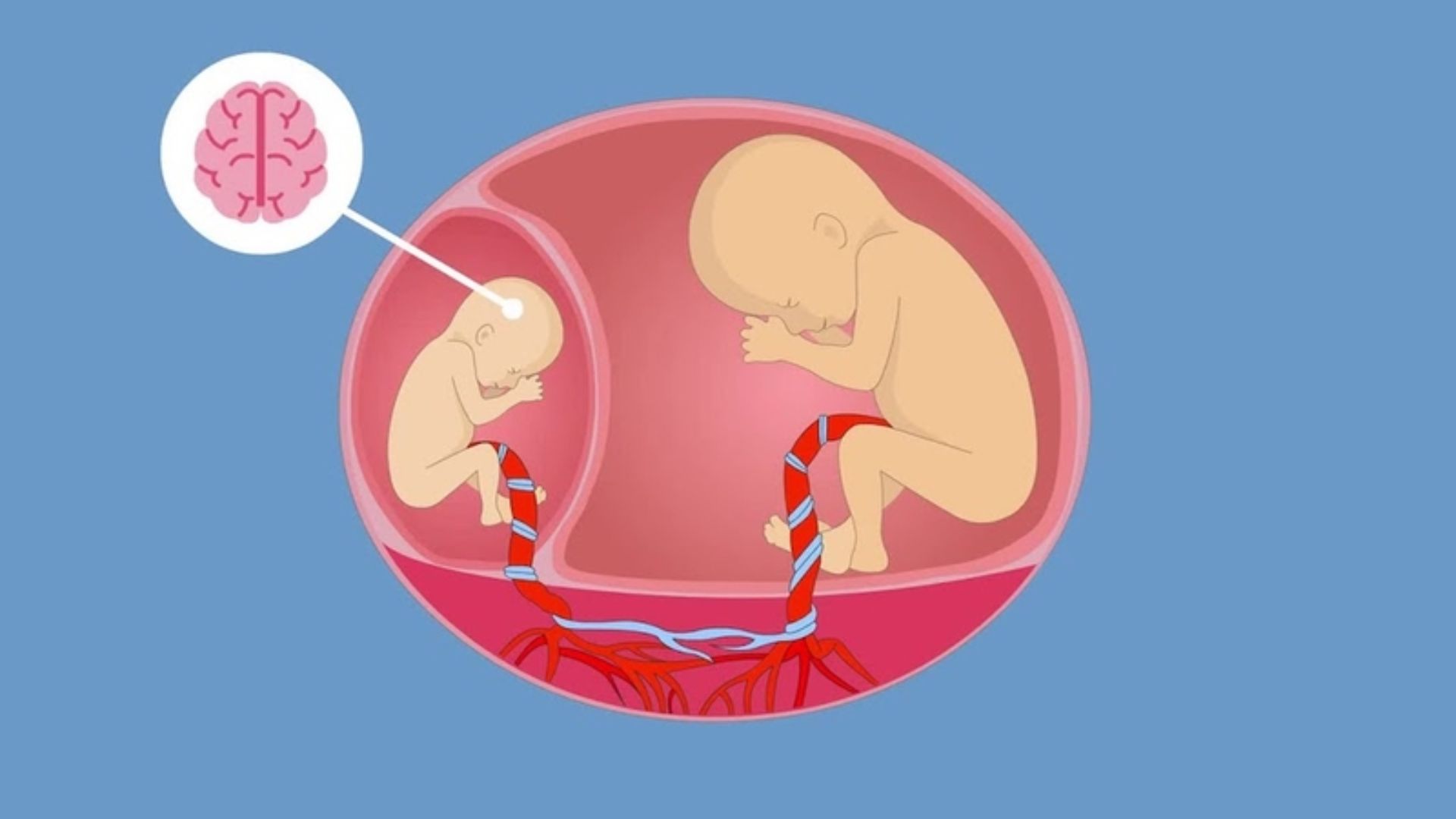 Hội chứng truyền máu song thai là một biến chứng thai kỳ nguy hiểm