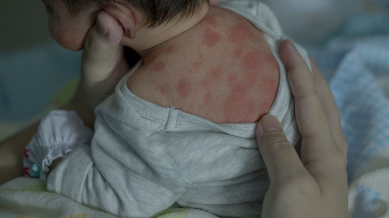 Trẻ em cũng có nguy cơ cao mắc hồng ban nút, đặc biệt sau khi nhiễm trùng đường hô hấp hay viêm họng