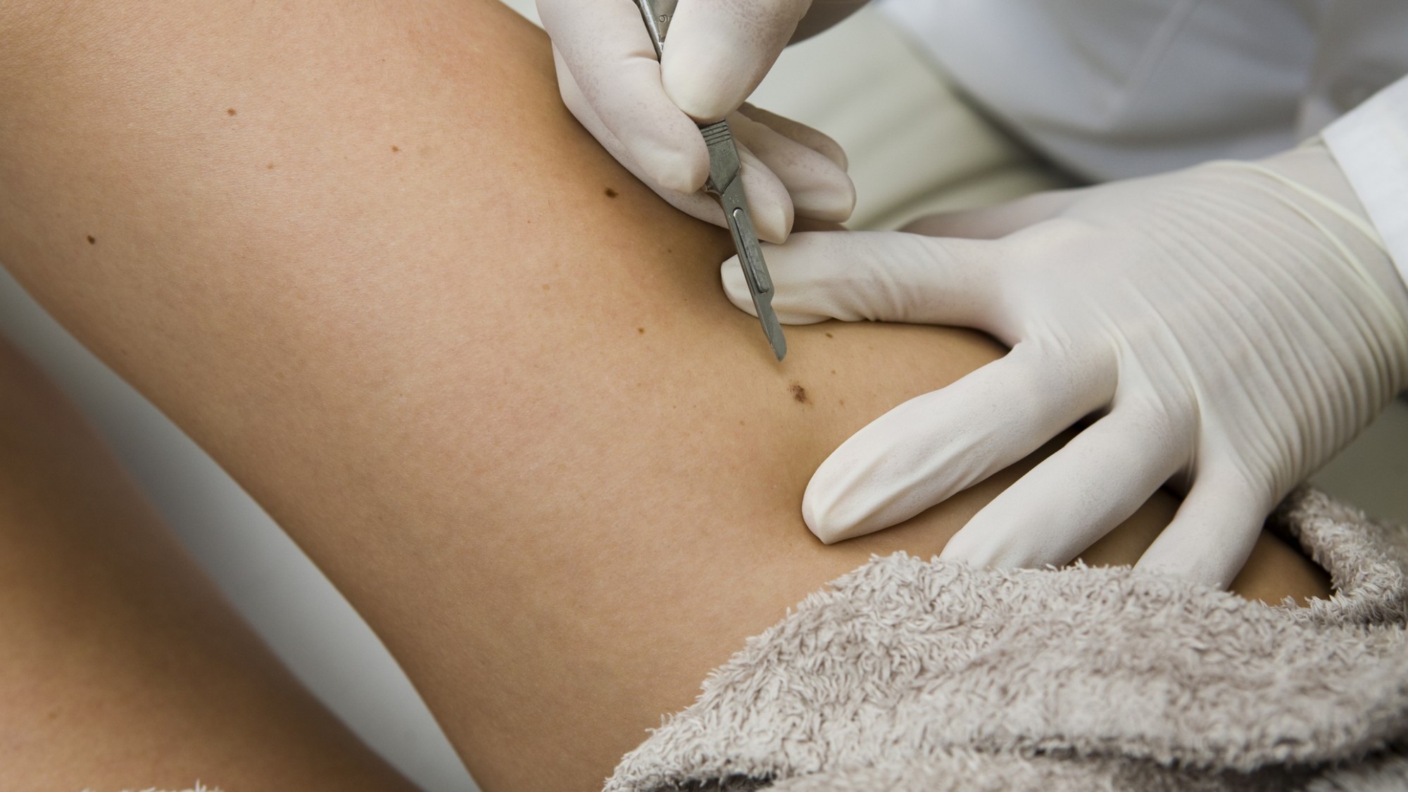 Sinh thiết da hỗ trợ chẩn đoán chính xác bệnh hồng ban nút