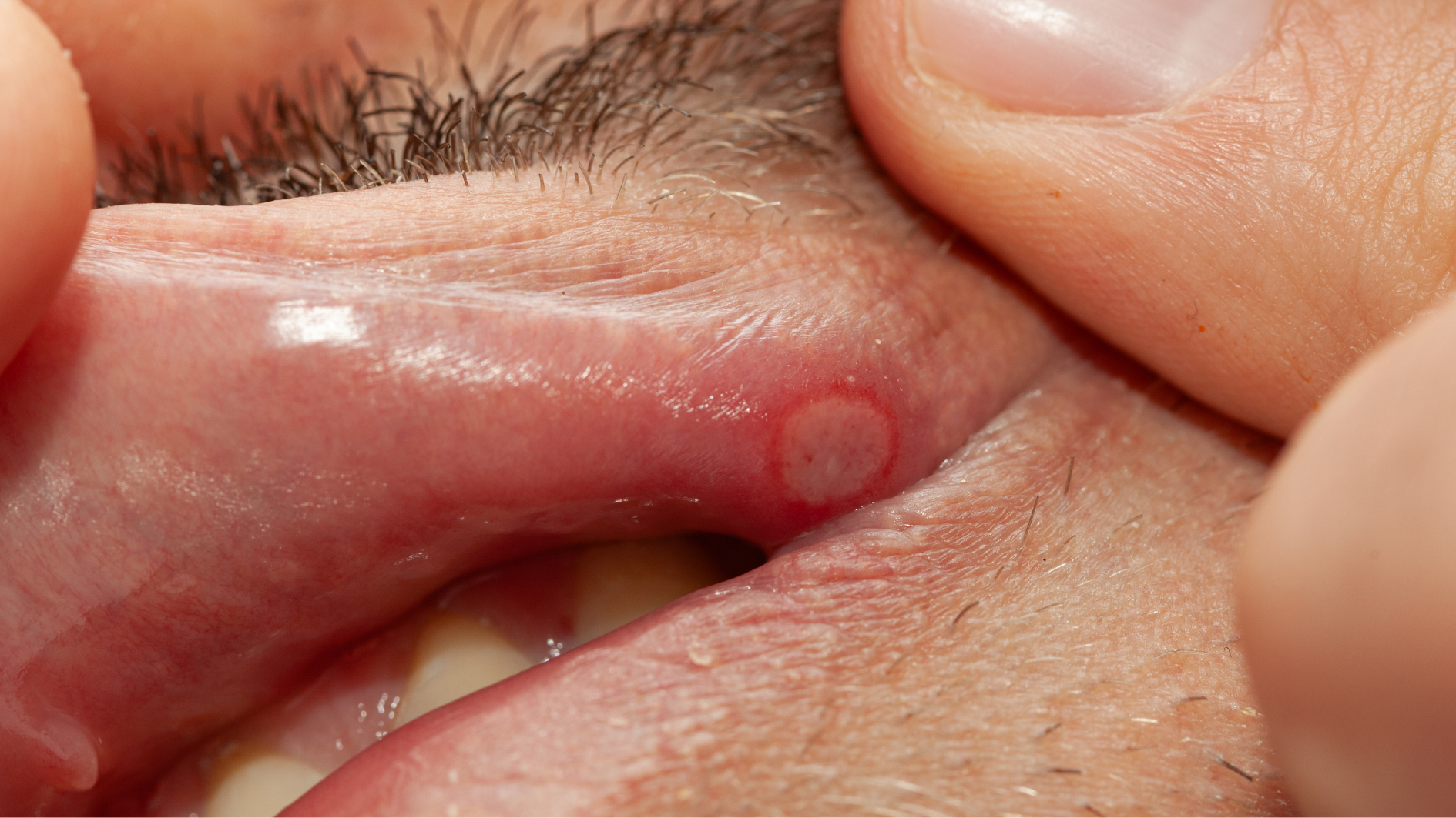 hpv-o-mieng-nguy-co-cao-gay-ung-thu-vom-hong (3).png