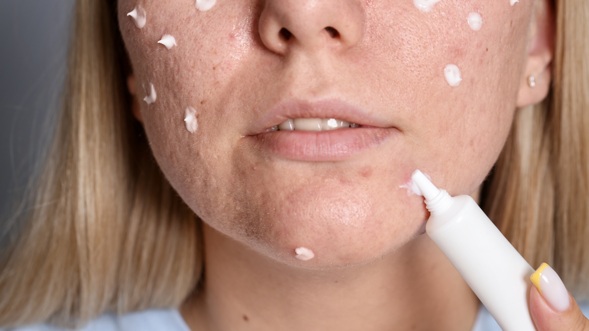 Sử dụng retinoids là một cách trị mụn bọc và tái tạo da