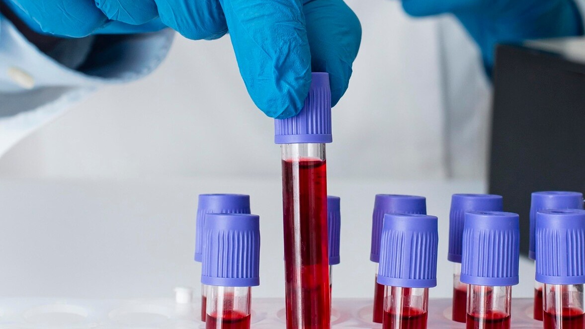 kết quả xét nghiệm viêm gan B dương tính