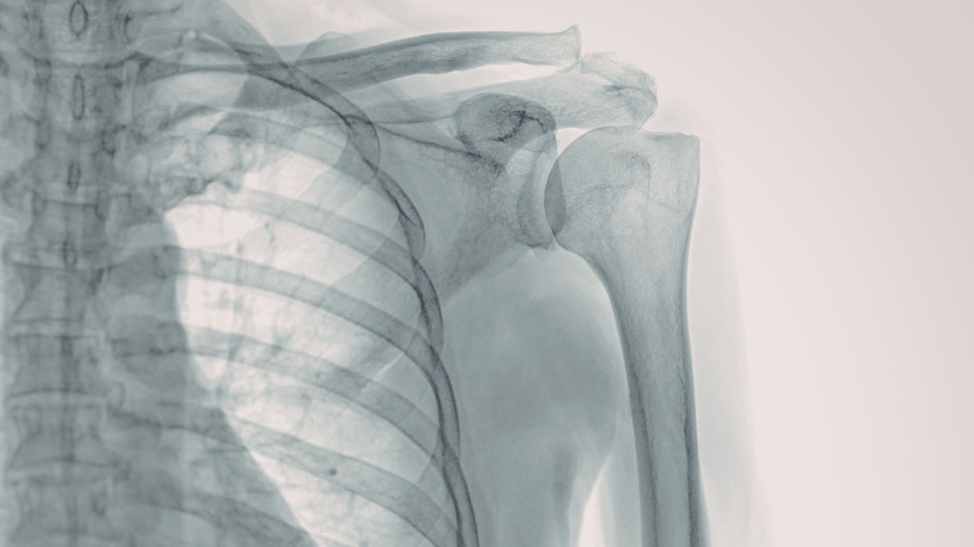 Xquang khớp vai phát hiện tổn thương xương trong chấn thương cấp tính