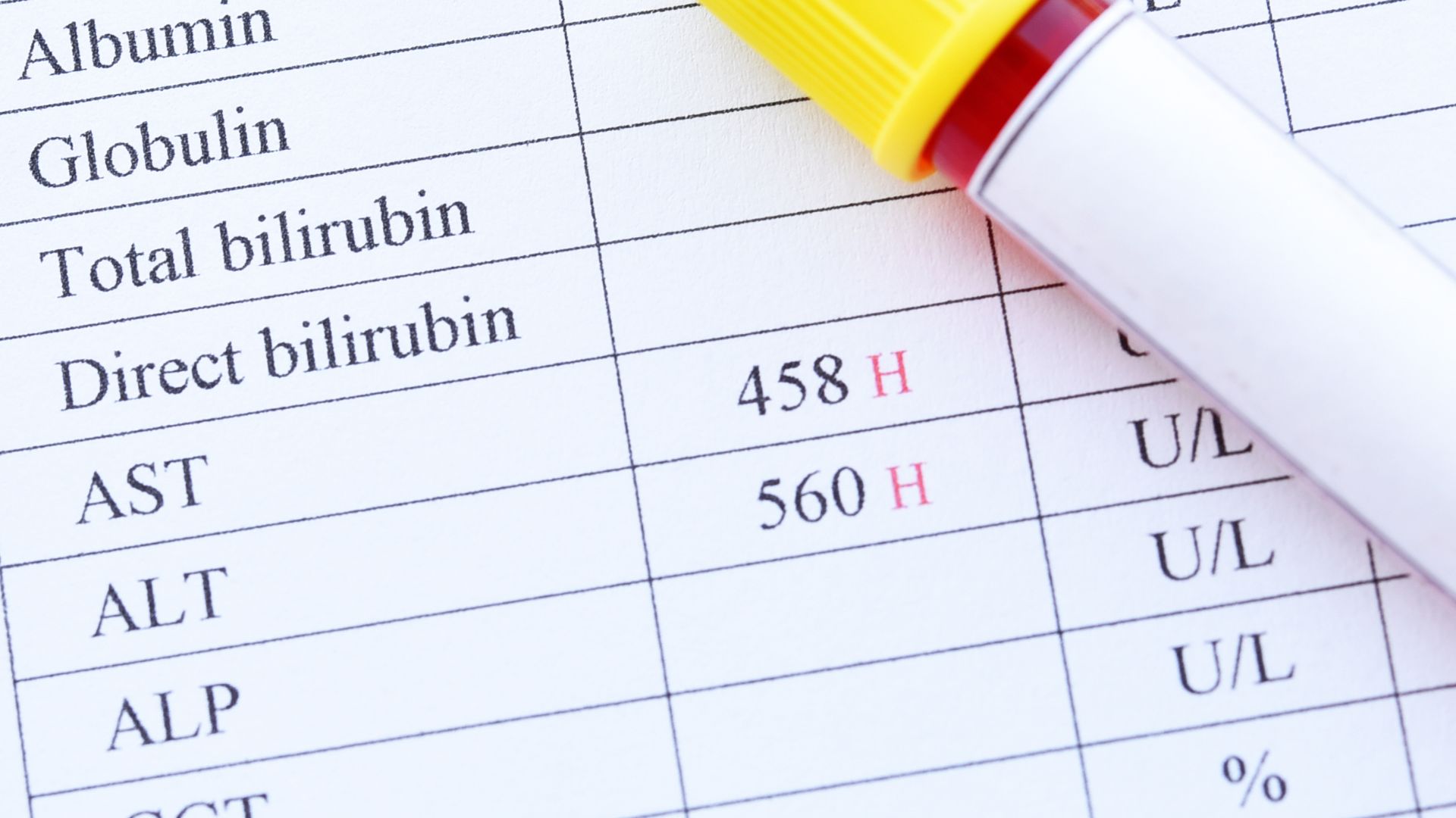 Men gan tăng cao phản ánh tế bào gan đang bị tổn thương