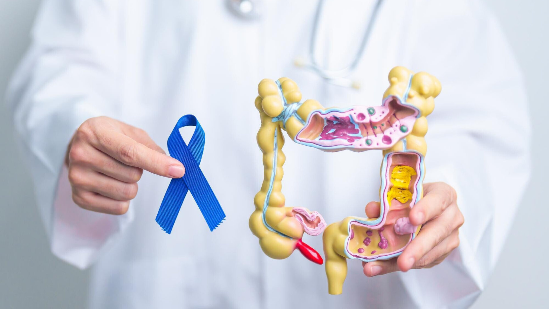 Polyp đại tràng là có thể lành tính hoặc mang tính chất tiền ung thư đại tràng