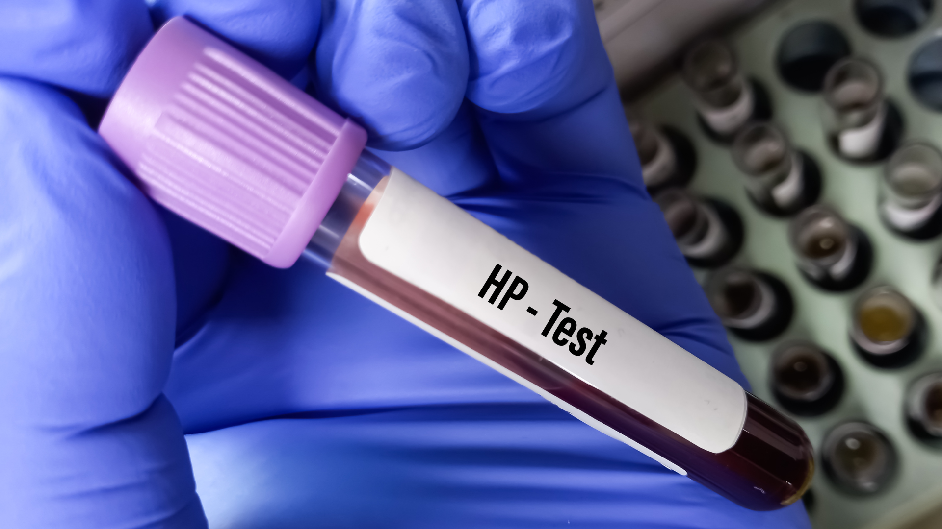 Khi nào cần xét nghiệm vi khuẩn HP? Những cách xét nghiệm phát hiện vi khuẩn HP hiện nay? 1