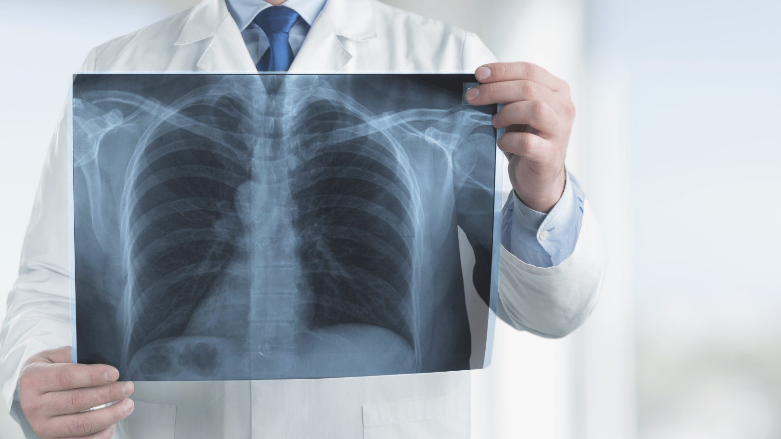 Khí phế thũng là một loại bệnh phổi tắc nghẽn mạn tính (COPD)