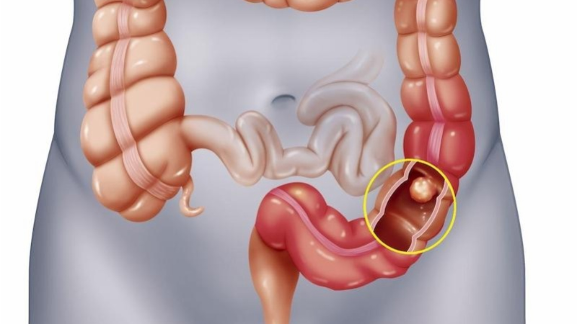 Khối u đại tràng là mảng tế bào tăng sinh bất thường, đa dạng kích thước, cần theo dõi sớm