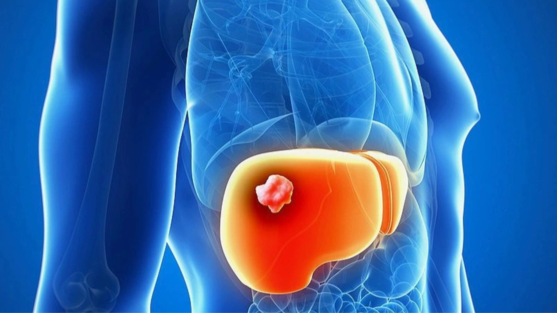 Khối u trong gan có nguy hiểm không? Nhiều trường hợp lành tính và phát triển chậm, không quá đáng lo