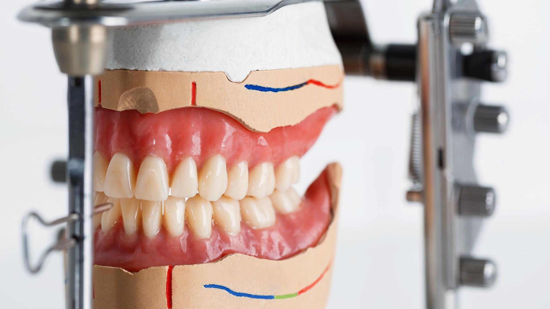 Khớp cắn đối đầu - Vấn đề răng miệng không thể bỏ qua 1