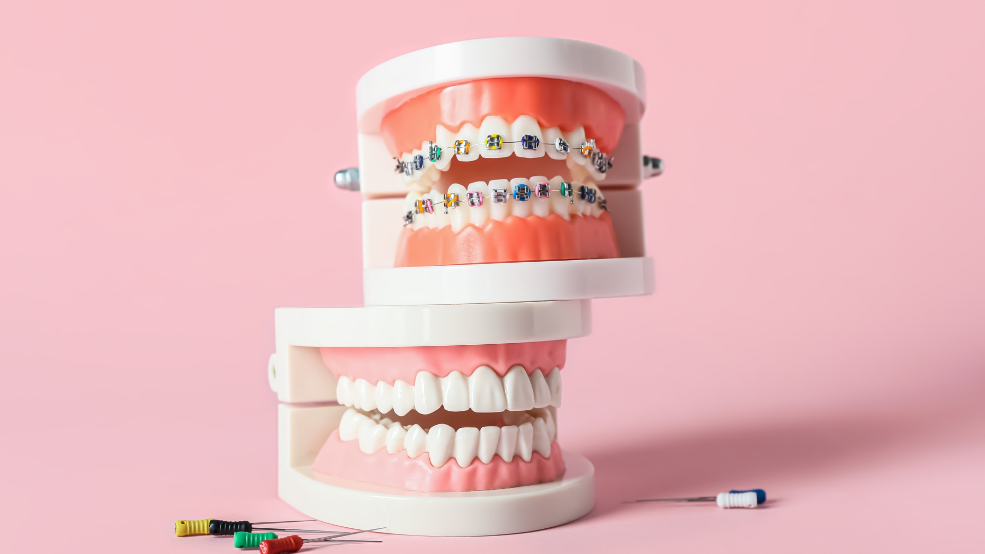 Khớp cắn ngược loại 3: Nhận diện và giải pháp điều trị hiệu quả 2