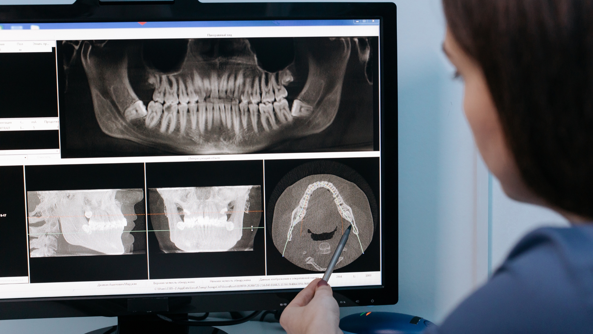 Khớp cắn ngược loại 3: Nhận diện và giải pháp điều trị hiệu quả 3